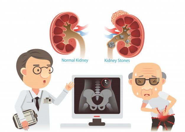 kidney-stones-illustration_99715-81